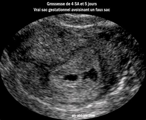 image faux sac gestationnel